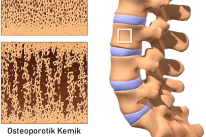 Sessiz Tehlike "Kemik Erimesi ve Beslenme" OSTEOPOROZ